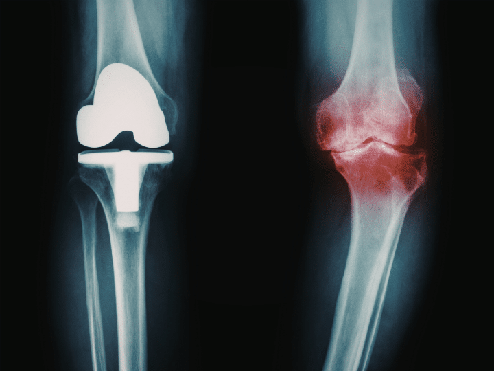 Osteoarthritis Treatment